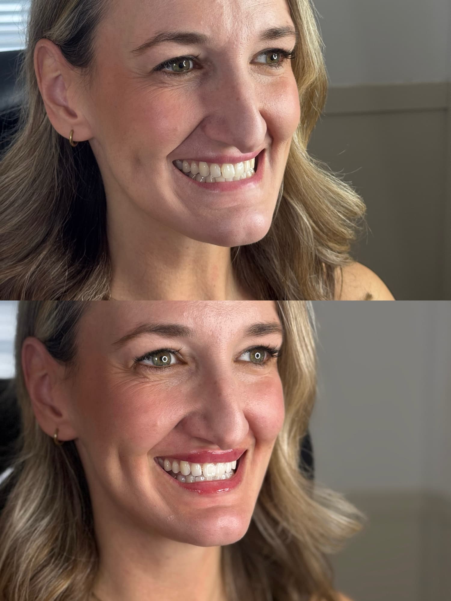 Lip filler before and after