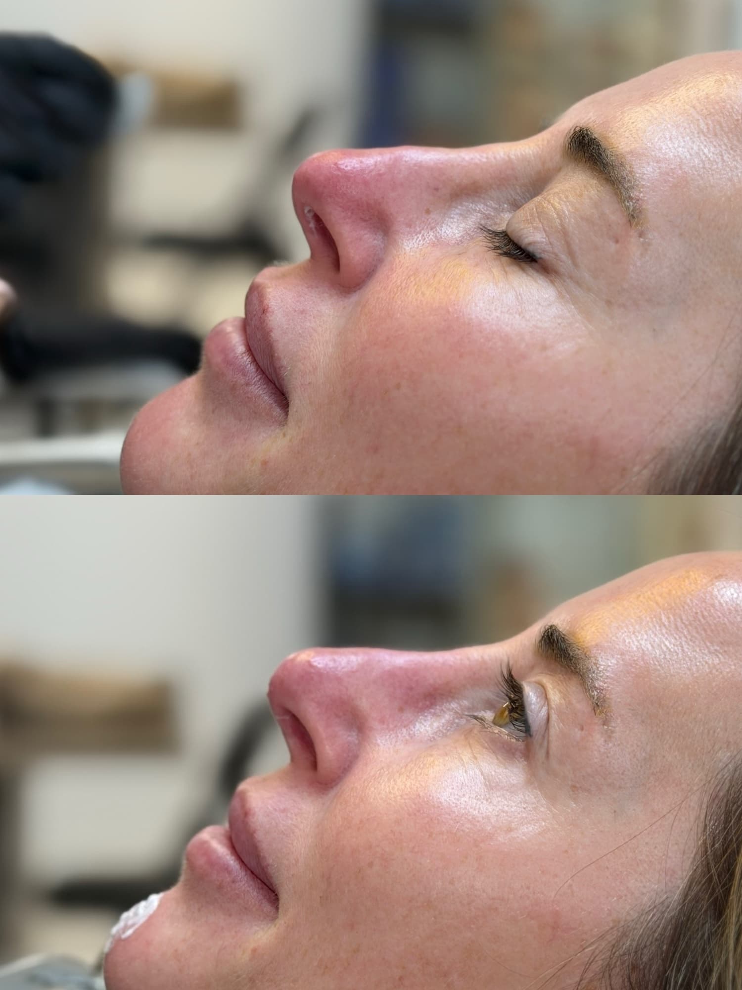 Non surgical nose filler before and after