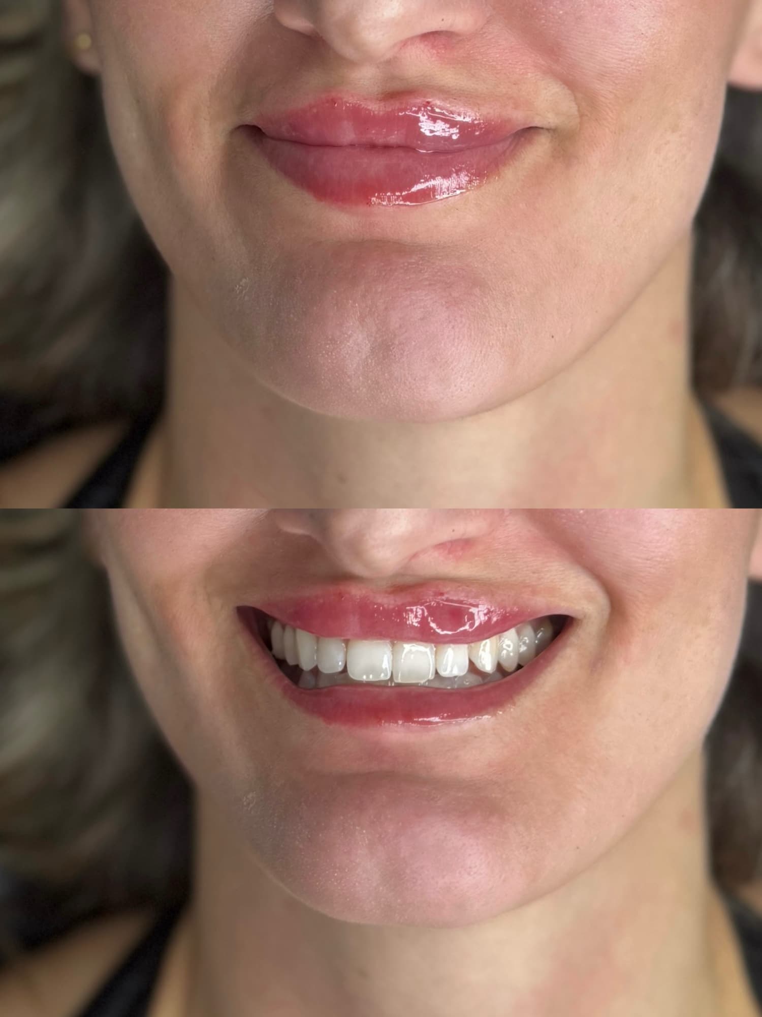 Lip filler before and after