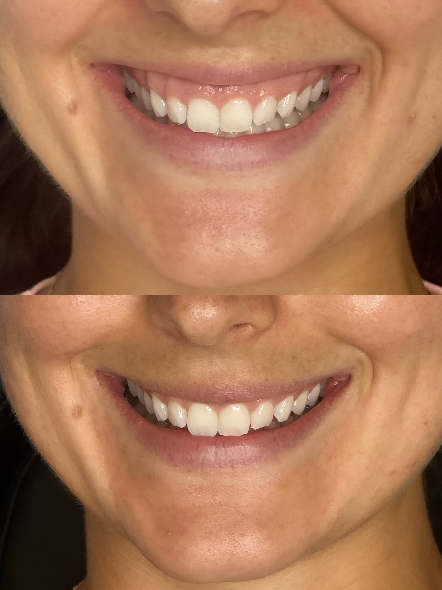 Lip flip and anti wrinkle before and after