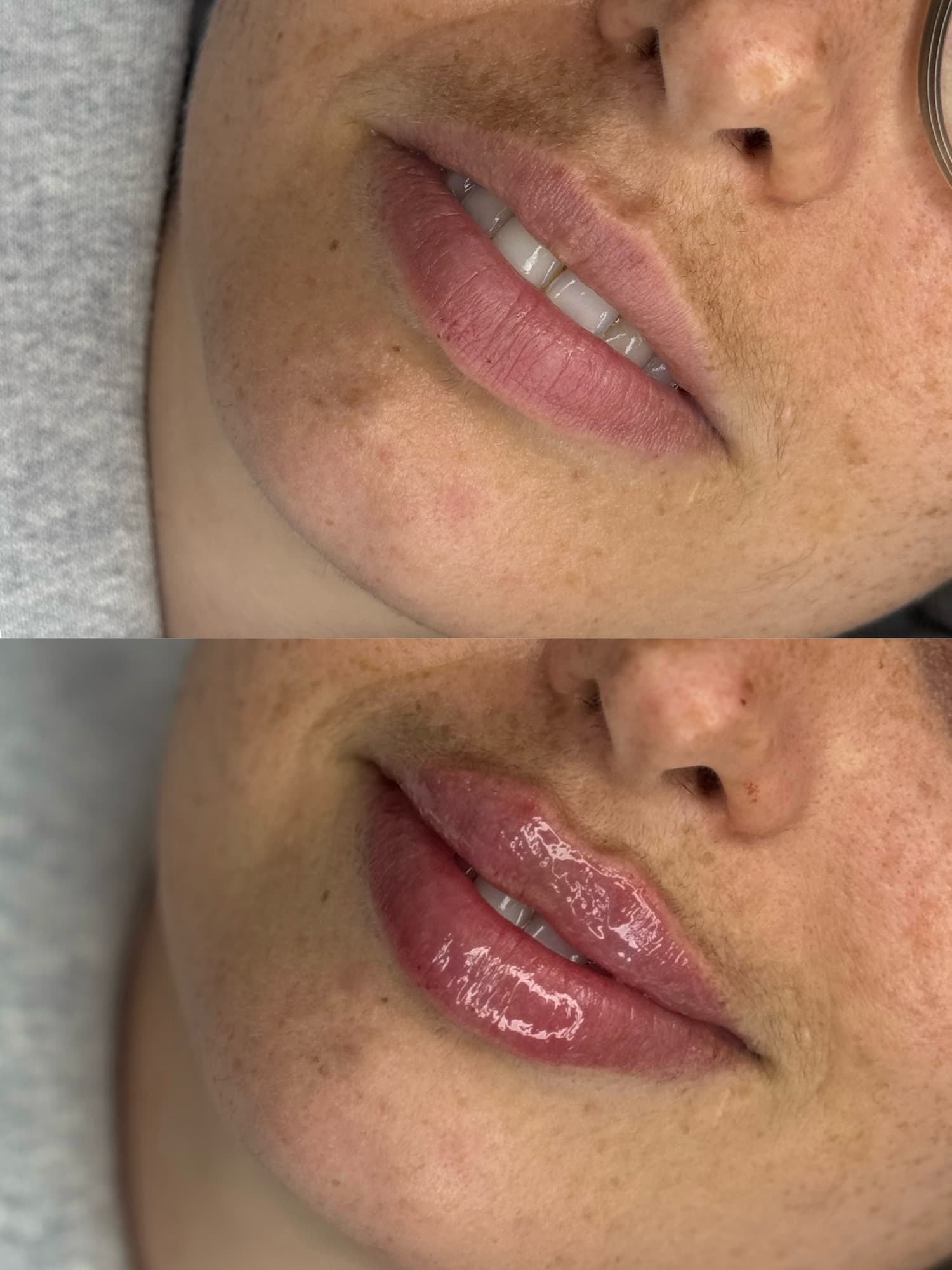 Lip filler before and after