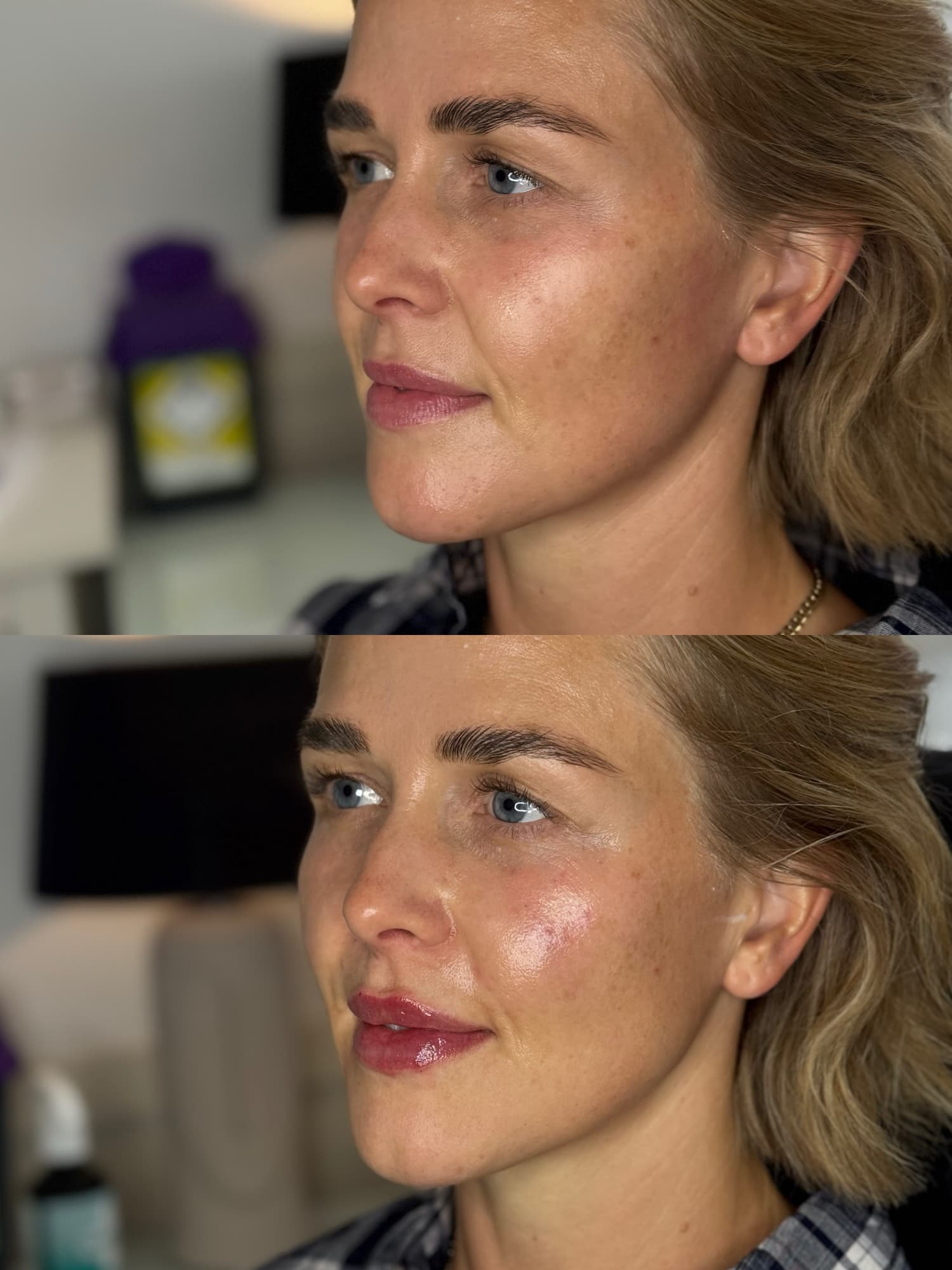 Cheek lip and nasolabial filler before and after