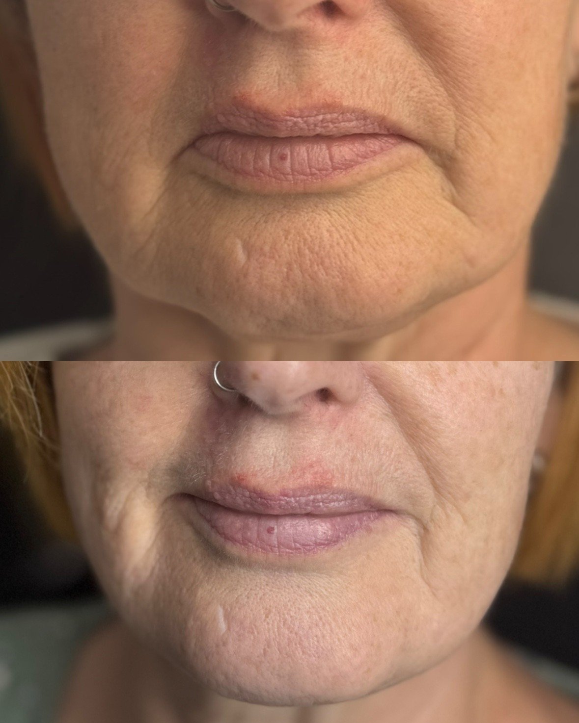 Before and After: Anti-wrinkle