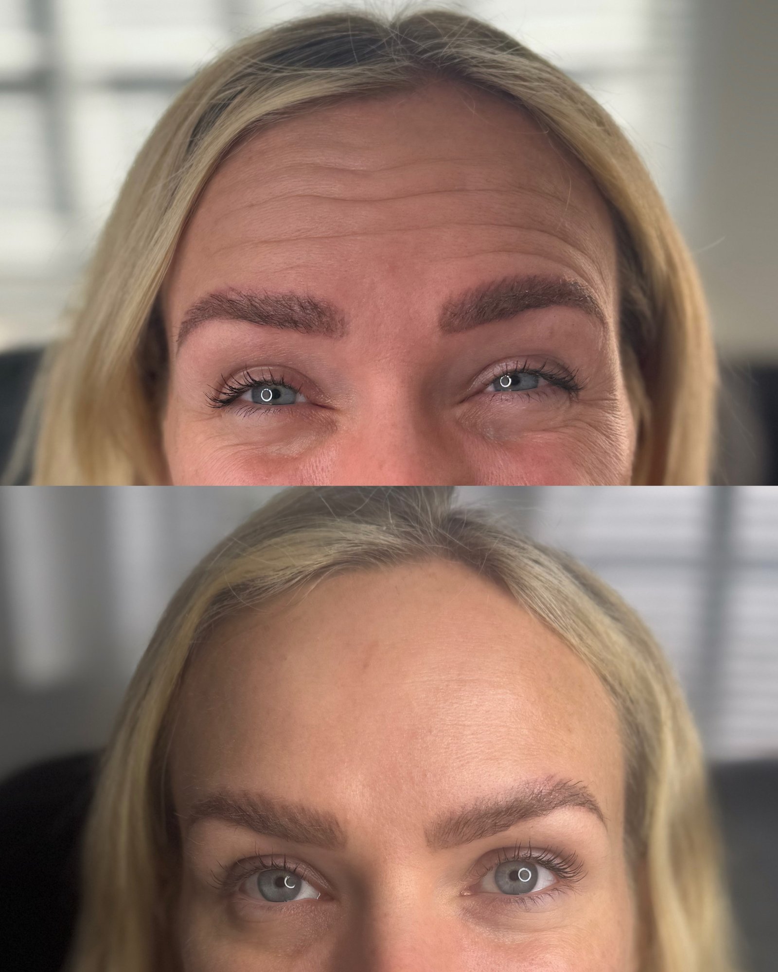 Before and After:  Chin Filler