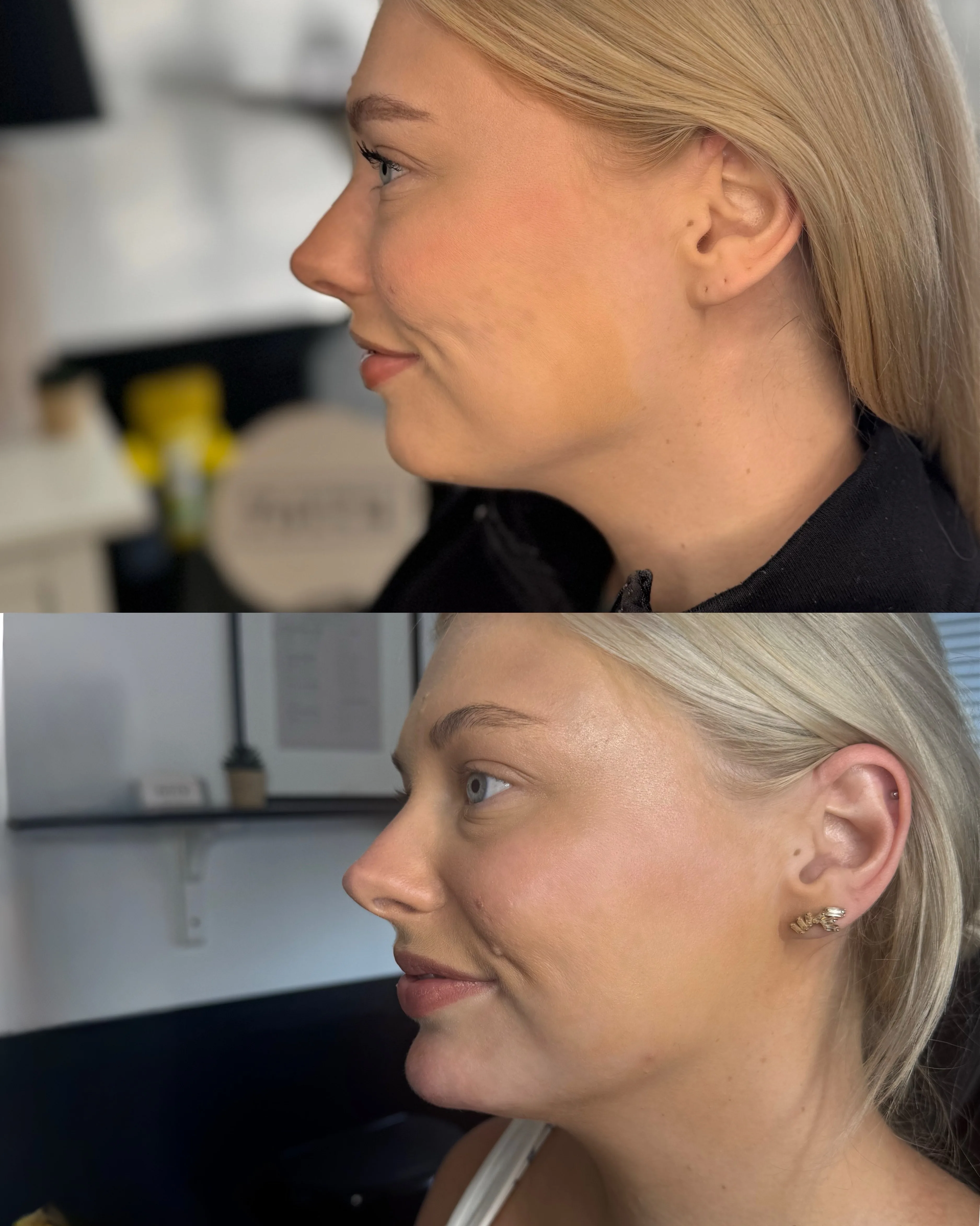 DAO treatment