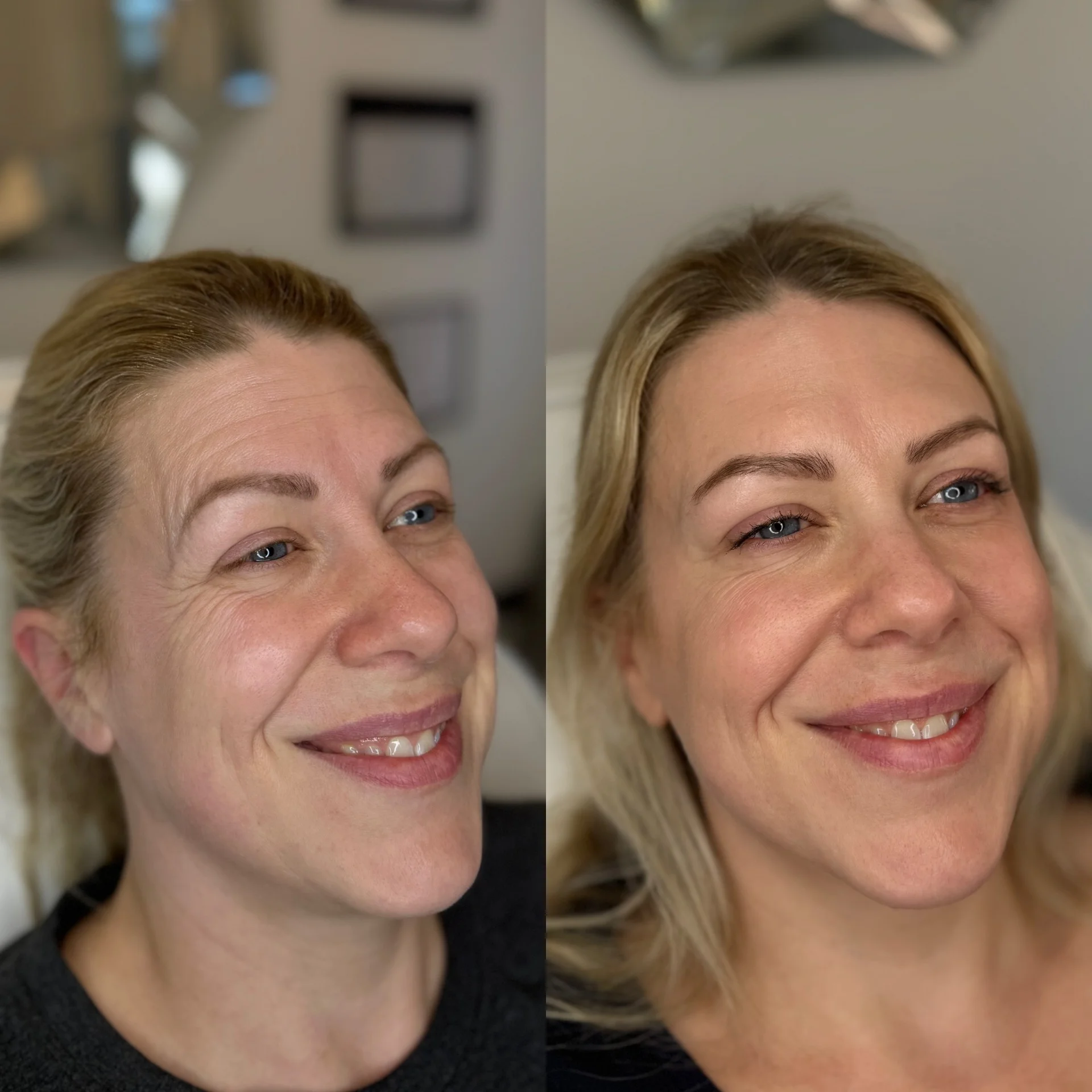 Before and After Anti-Wrinkle Treatment on 3 Areas at The Aesthetic Touch