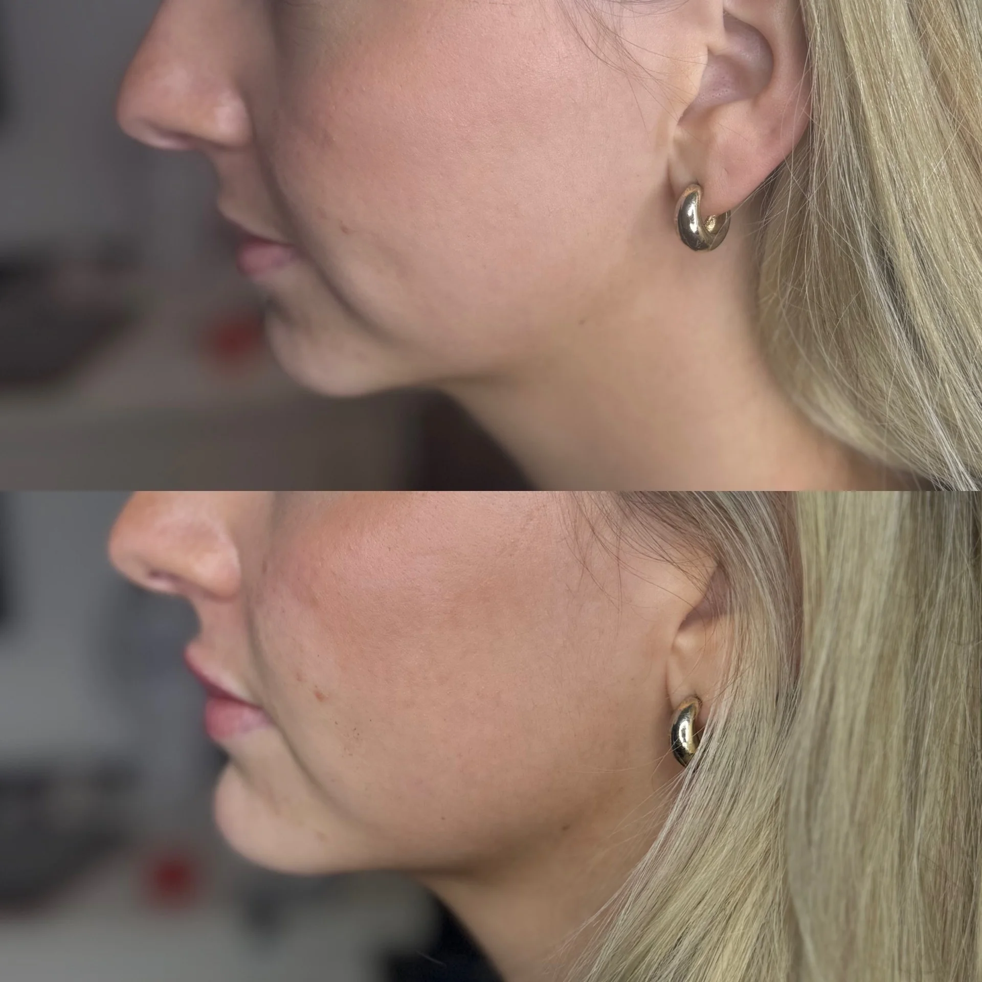 Before and After Chin Filler Treatment at The Aesthetic Touch