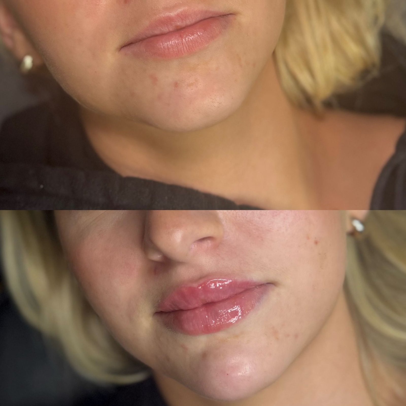 Before and After Chin Contouring Procedure at The Aesthetic Touch