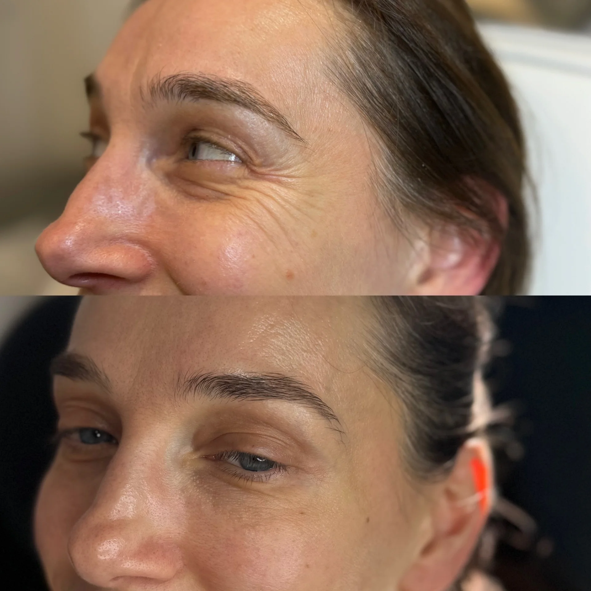 Before and After Crows Feet Anti-wrinkle Injections at The Aesthetic Touch