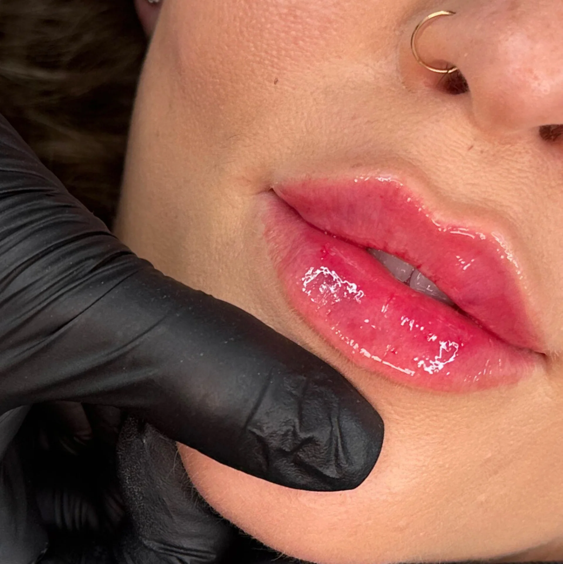 Before and After Lip Filler Enhancement at The Aesthetic Touch