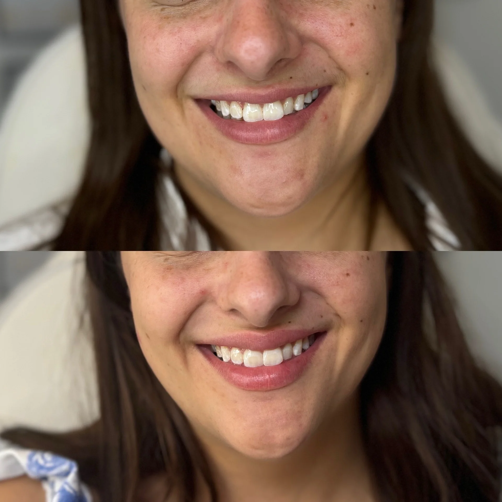 Before and After Lip Flip Treatment at The Aesthetic Touch