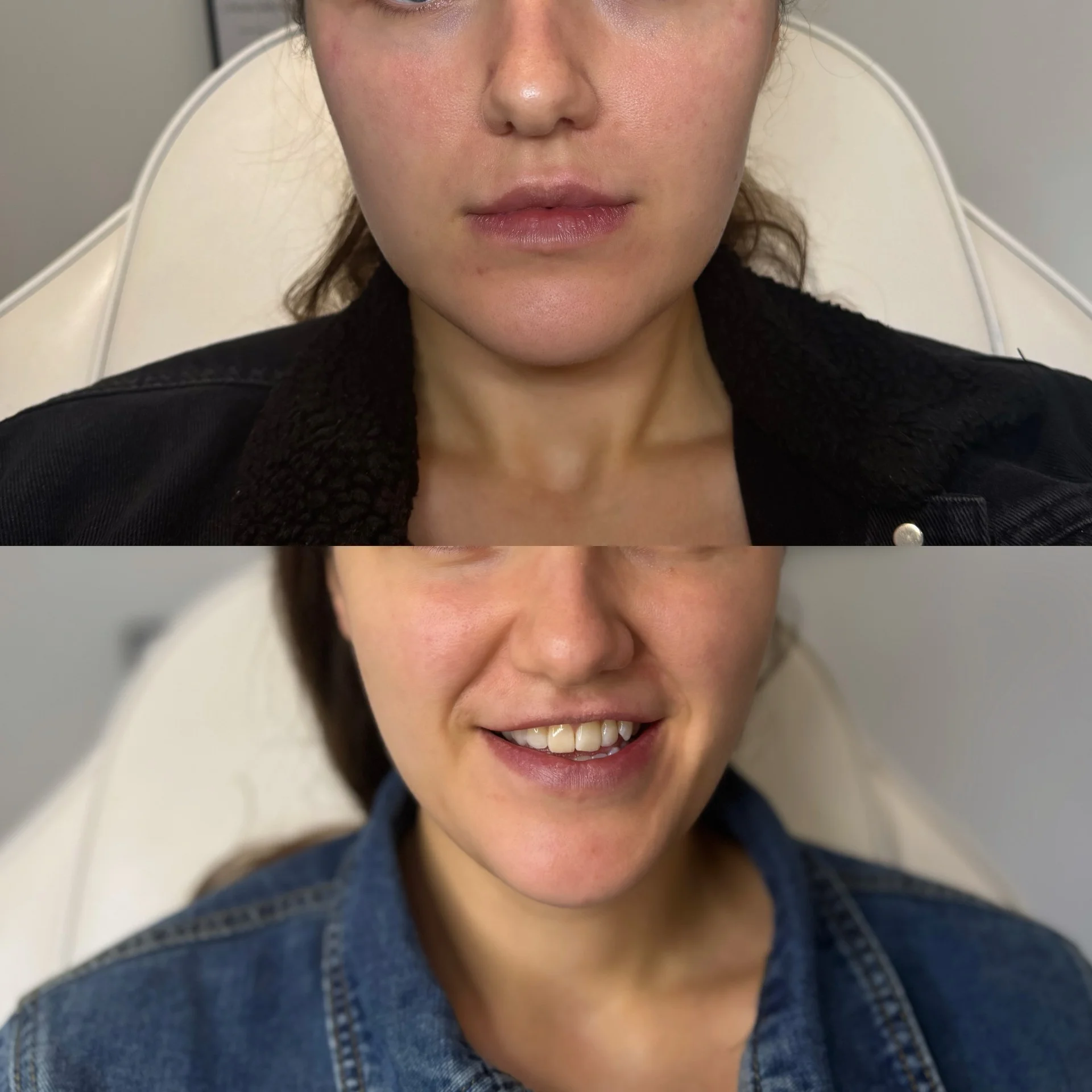 Before and After Masseter Muscle Relaxing Treatment at The Aesthetic Touch