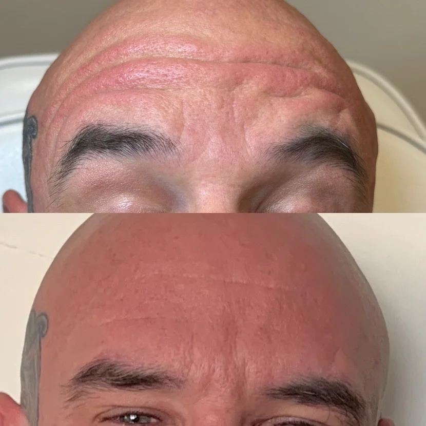 Before and After Forehead Anti-Wrinkle Treatment at The Aesthetic Touch