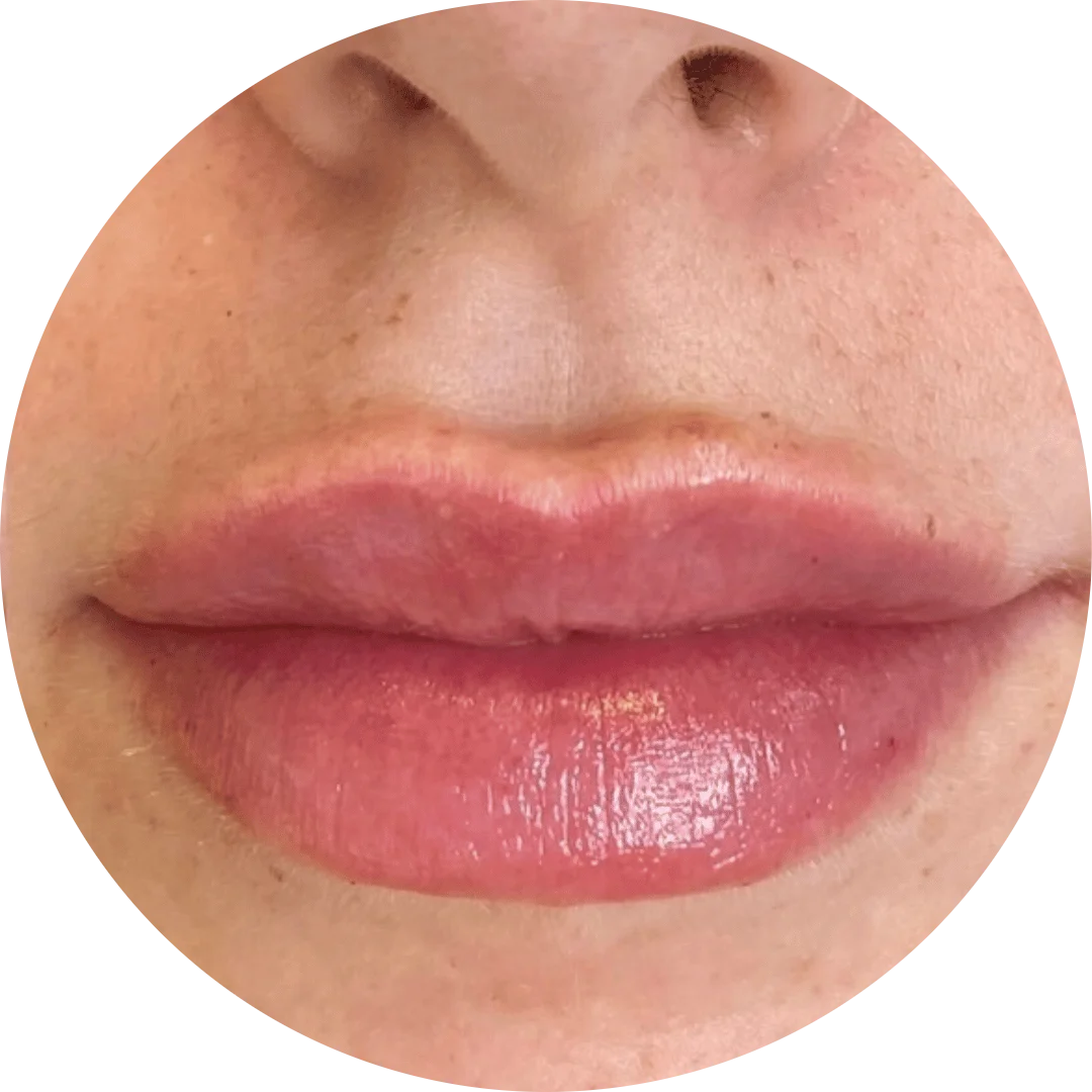 Lip Booster Treatment for Enhanced Lips