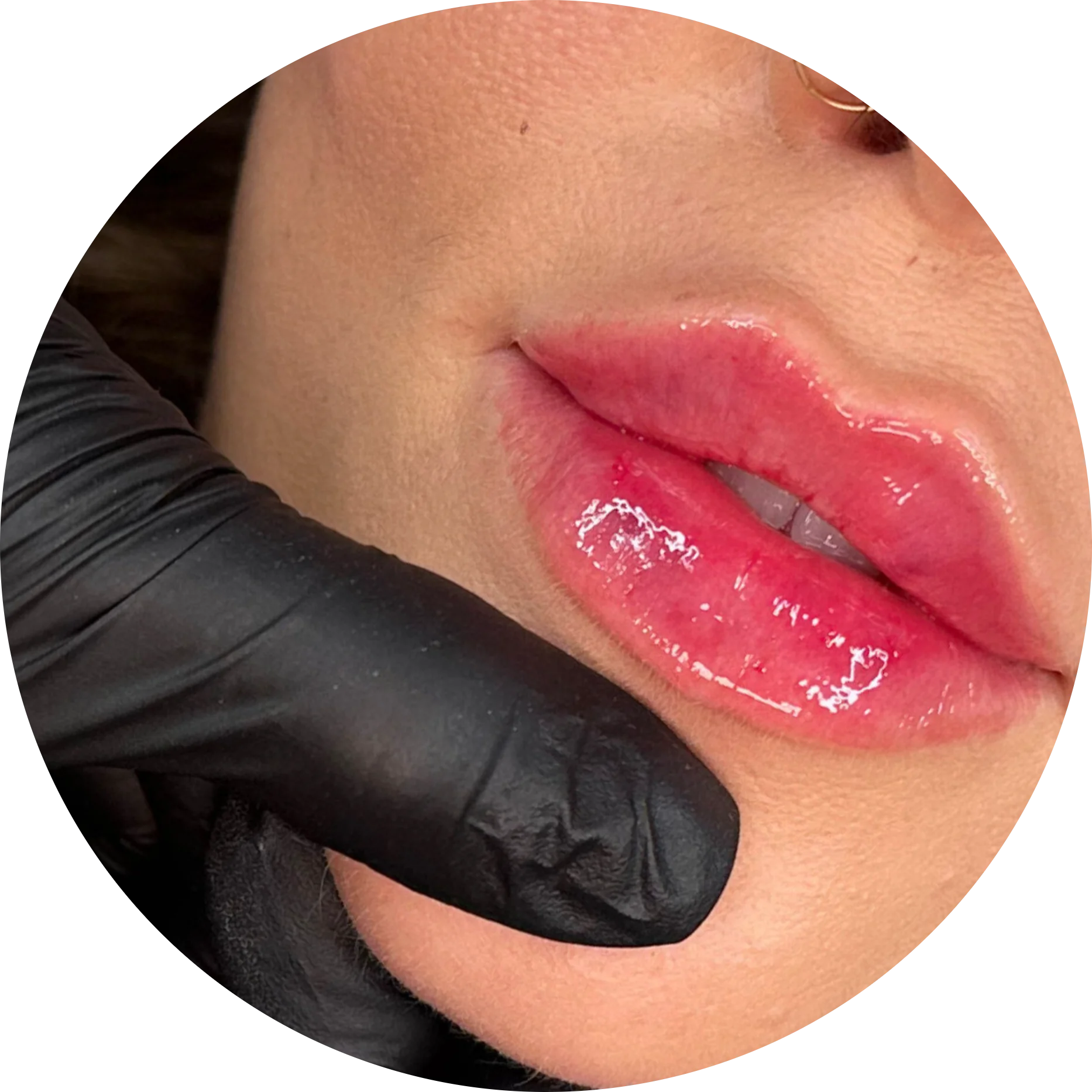 Lip Filler Treatment at The Aesthetic Touch